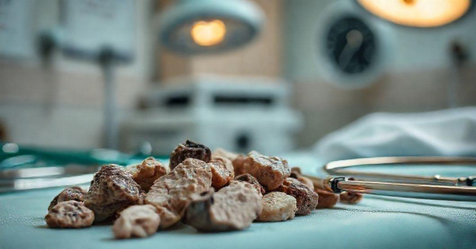 Entenda os Cálculos Urinários e Como Eles Impactam sua Saúde