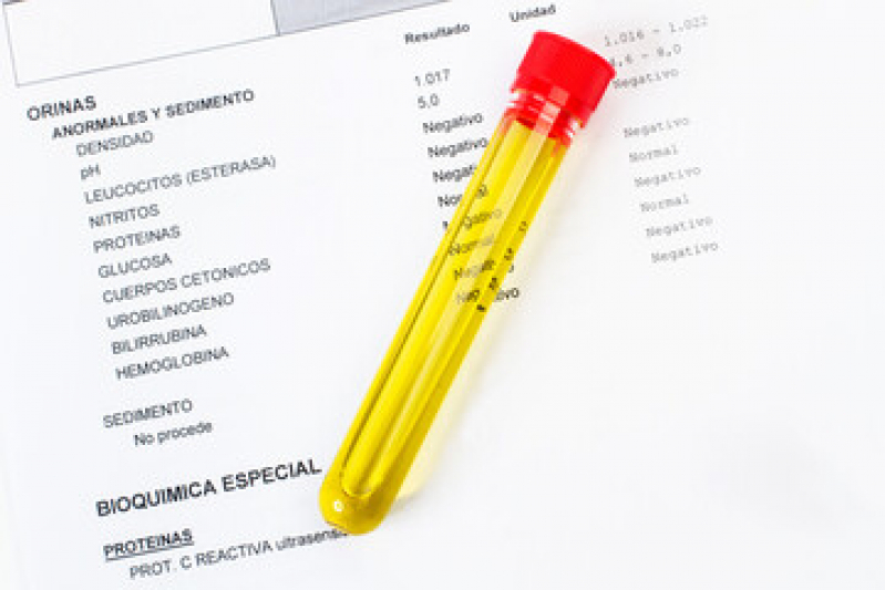 Exame de Urina Sedimentoscopia Jamaica - Exame de Osmolaridade Urinálise
