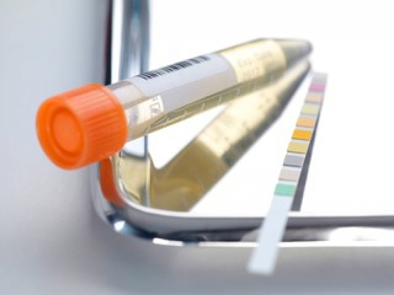 Valor de Exame Urina Sedimentoscopia Porto Saboó - Exame de Urina Automatizado